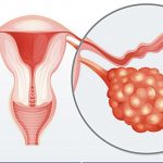 Descopera mai multe despre sindromul ovarelor polichistice